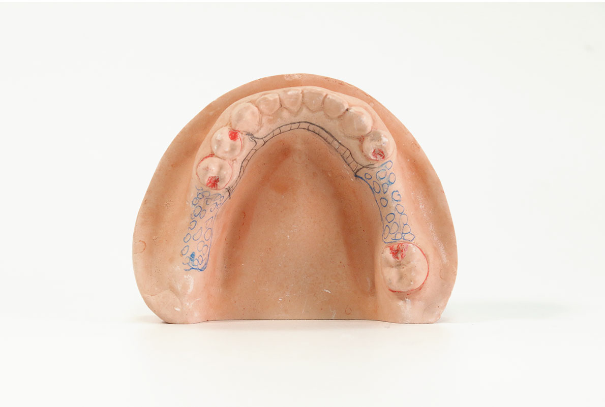 denture model