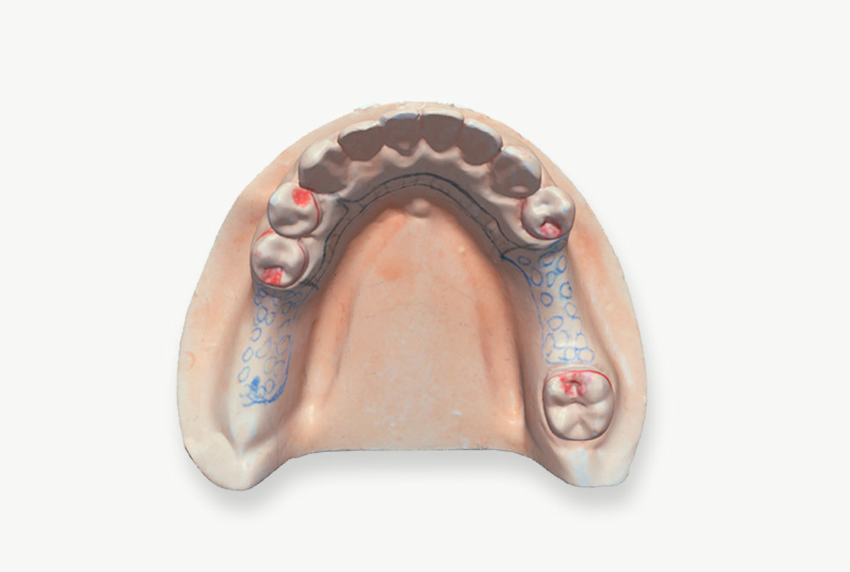 denture model