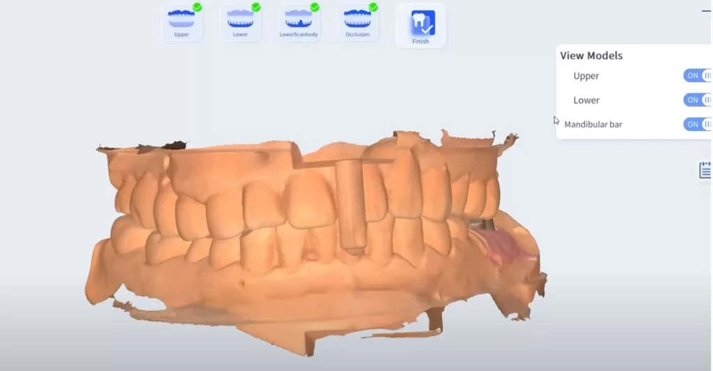 Intraoral Scanner scan implant case