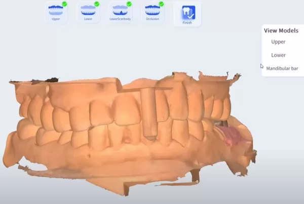 Intraoral Scanner scan implant case