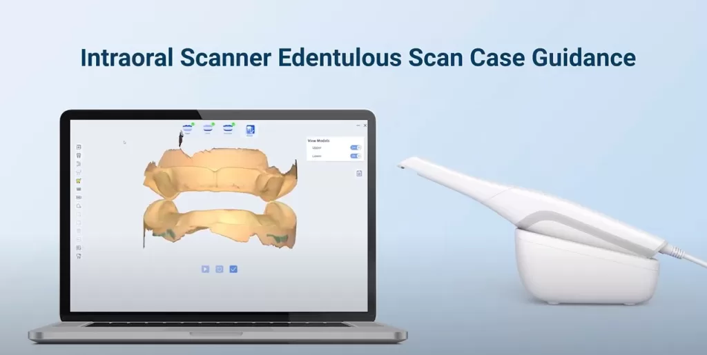 Edentulous case scan
