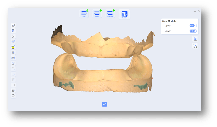 edentulous case scan with intraoral scanner