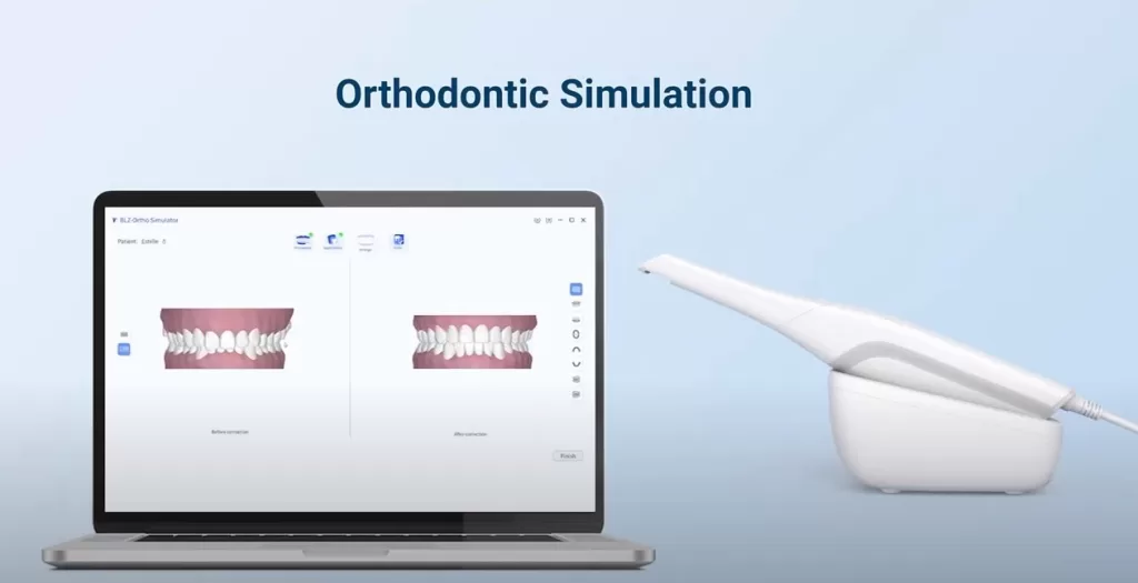 Intraoral Scanner Orthodontic Simulation