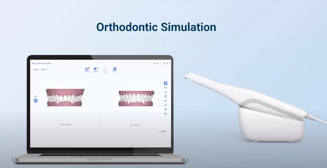 How to Use Intraoral Scanner to Do Orthodontic Simulation
