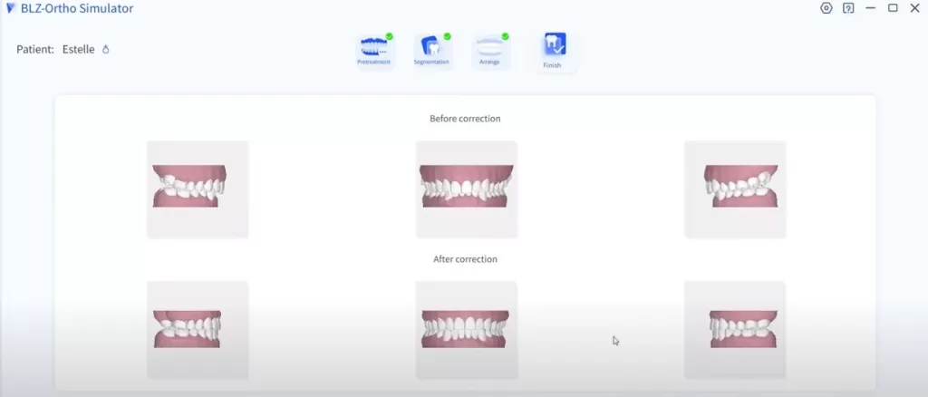 Intraoral scanner orthodontic simulation finished
