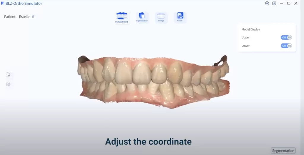 Intraoral scanner orthodontic simulation pretreatment
