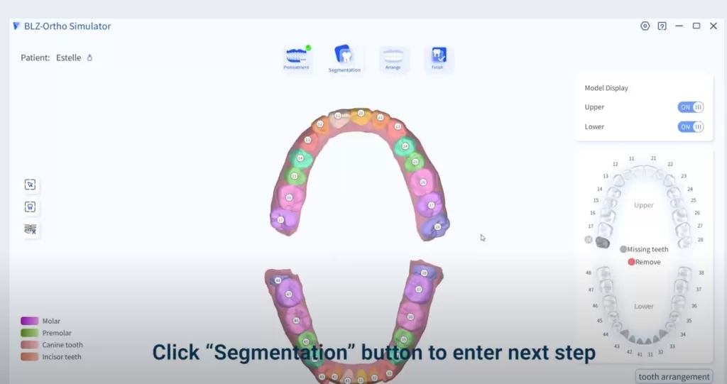 Intraoral scanner orthodontic simulation segmentation