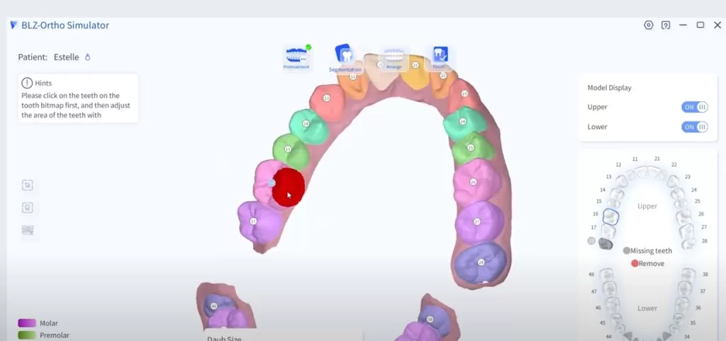 intraoral scanner orthodontic simulation regional adjustment