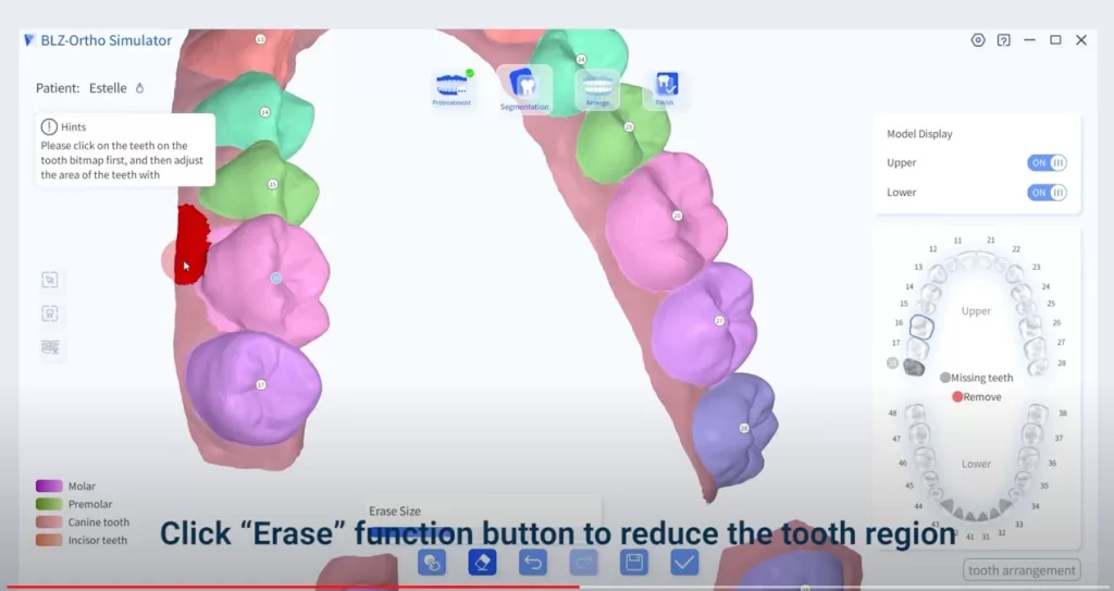 intraoral scanner orthodontic simulation regional adjustment