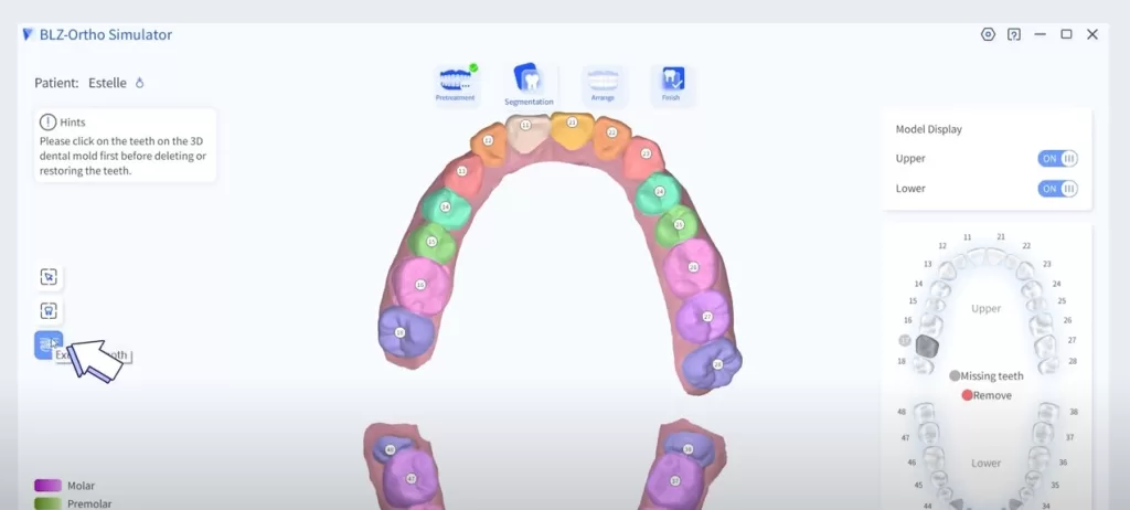 intraoral scanner orthodontic simulation extract teeth