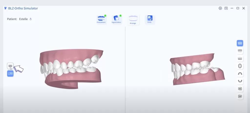 Intraoral scanner orthodontic simulation arrange